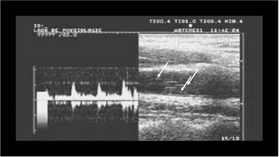 Increased Risk of Decompression Sickness When Diving With a Right-to-Left Shunt: Results of a Prospective Single-Blinded Observational Study (The “Carotid Doppler” Study)